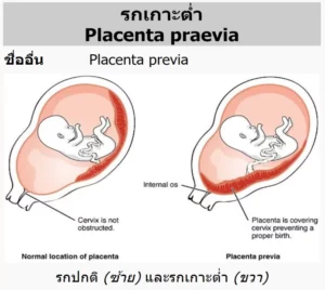 ภาวะรกเกาะต่ำ | โรงพยาบาลรวมใจรักษ์