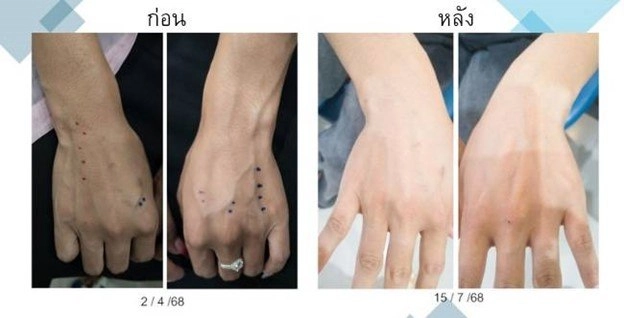 ภาพประกอบหลักการฉีดยารักษาเส้นเลือดปูดที่มือ